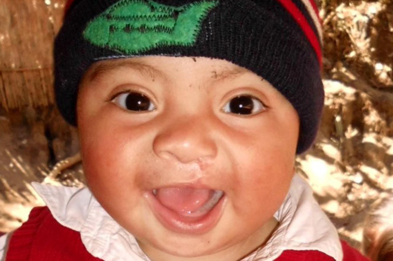 Surgery for Guatemalans with Cleft Lip and Palate